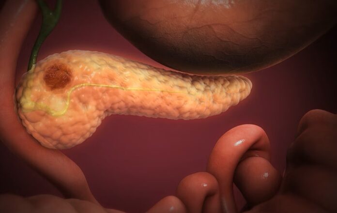 PancreaticCancer-1200x6751